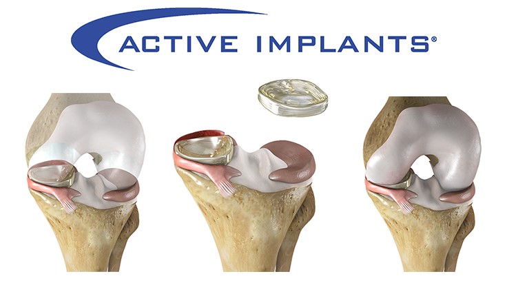 Breakthrough Device Designation For NUsurface Meniscus Implant Today